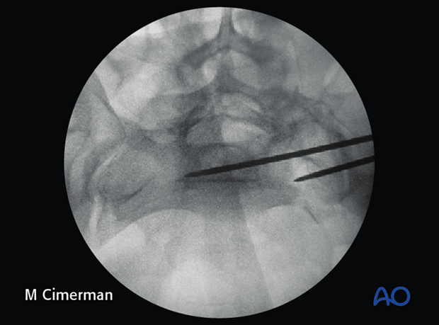 iliosacral screw insertion