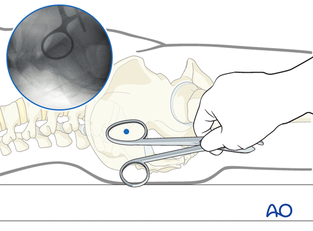 iliosacral screw insertion