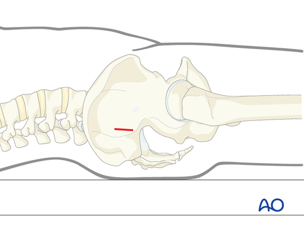 iliosacral screw insertion