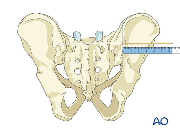 iliosacral screw insertion