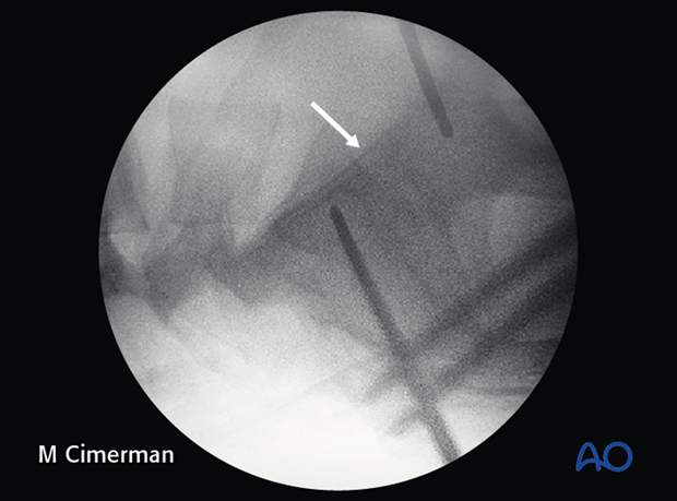 iliosacral screw insertion