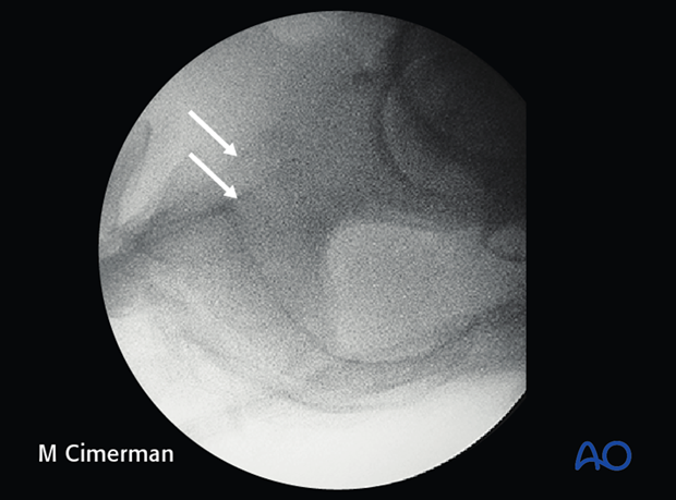 iliosacral screw insertion