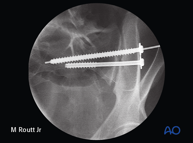 iliosacral screw insertion