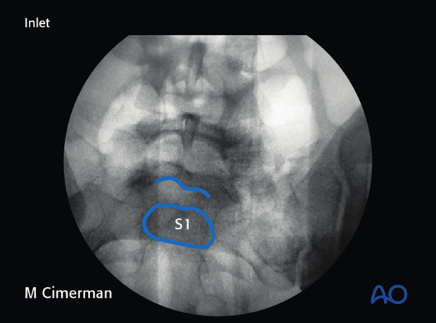 planning for is screw insertion