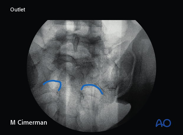 planning for is screw insertion