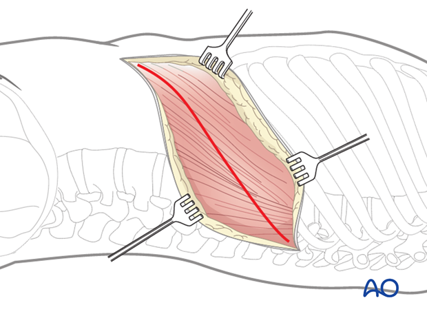 anterior approach to the lumbar spine