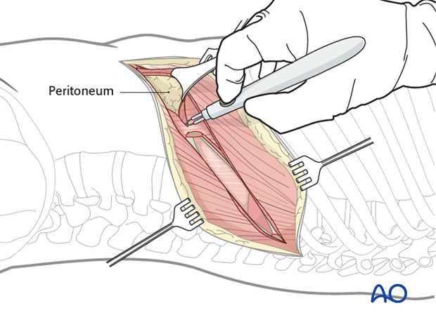 anterior approach to the lumbar spine