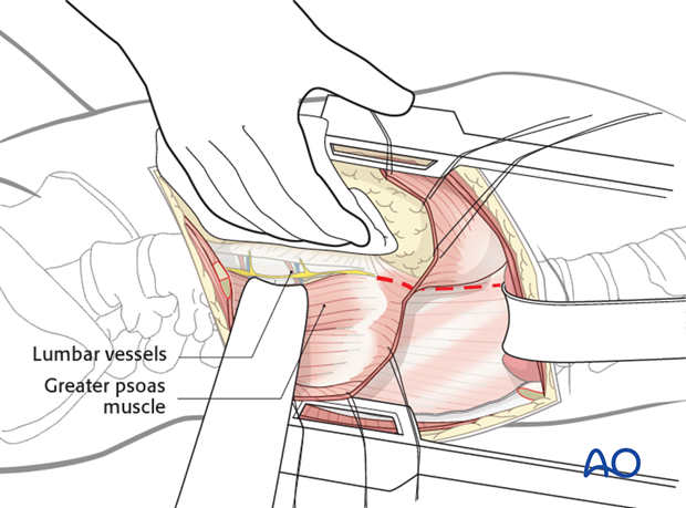 anterior approach to the lumbar spine