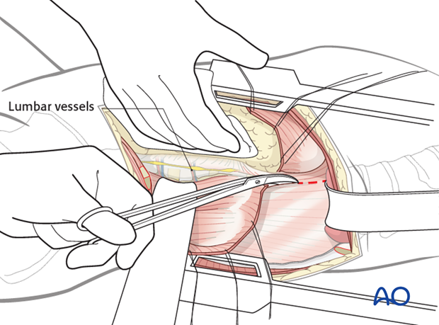 anterior approach to the lumbar spine