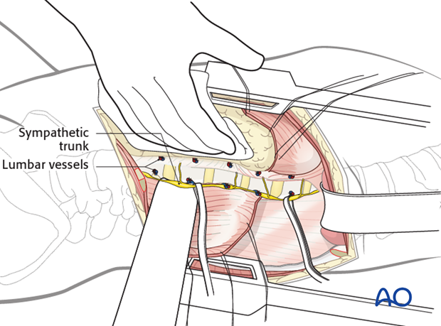 anterior approach to the lumbar spine