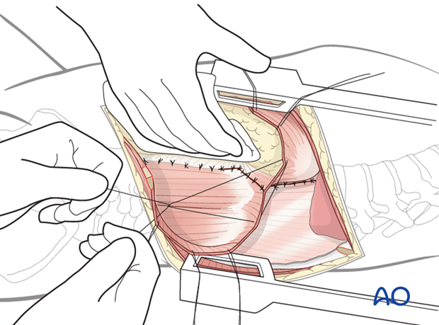 anterior approach to the lumbar spine