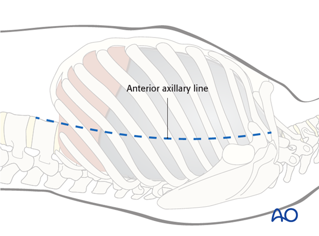 anterior thoracoscopic approach