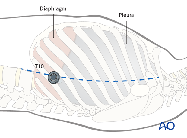 anterior thoracoscopic approach