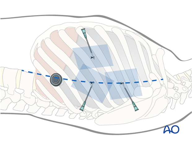 anterior thoracoscopic approach