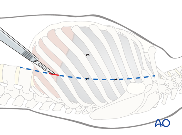 anterior thoracoscopic approach