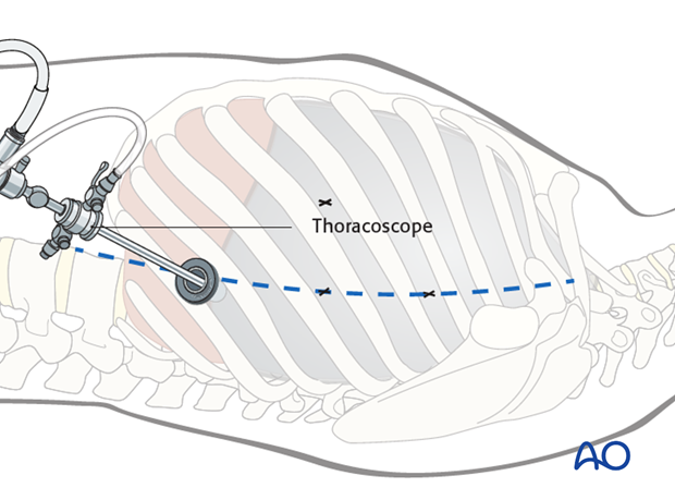 anterior thoracoscopic approach