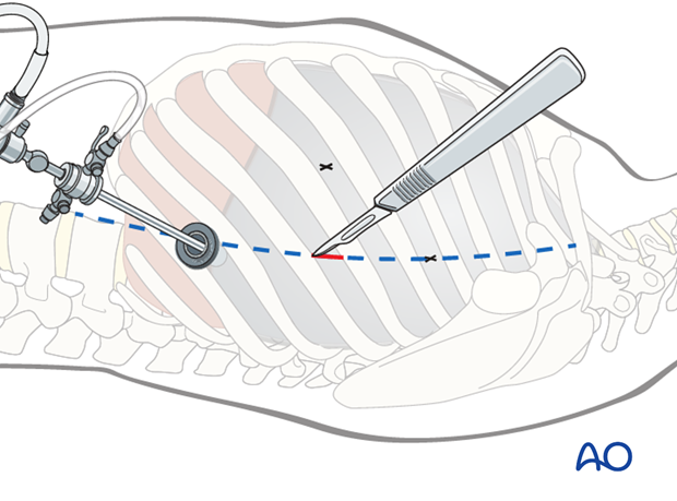 anterior thoracoscopic approach