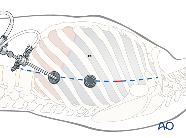 anterior thoracoscopic approach