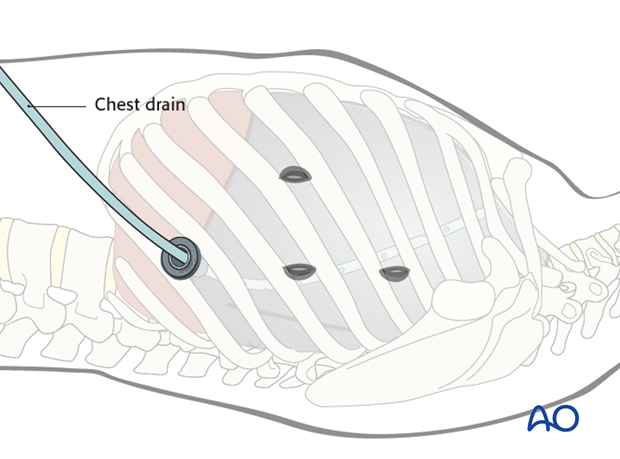 anterior thoracoscopic approach