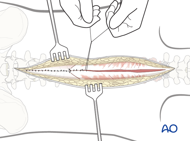 posterior approach