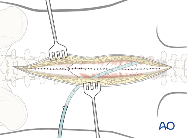 posterior approach