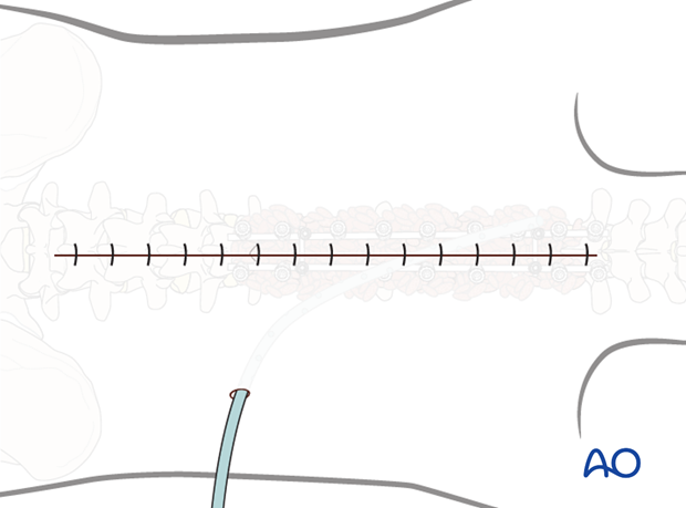 posterior approach