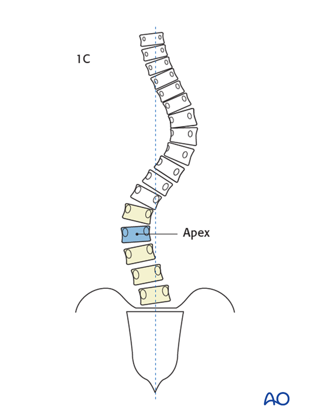 lenke classification