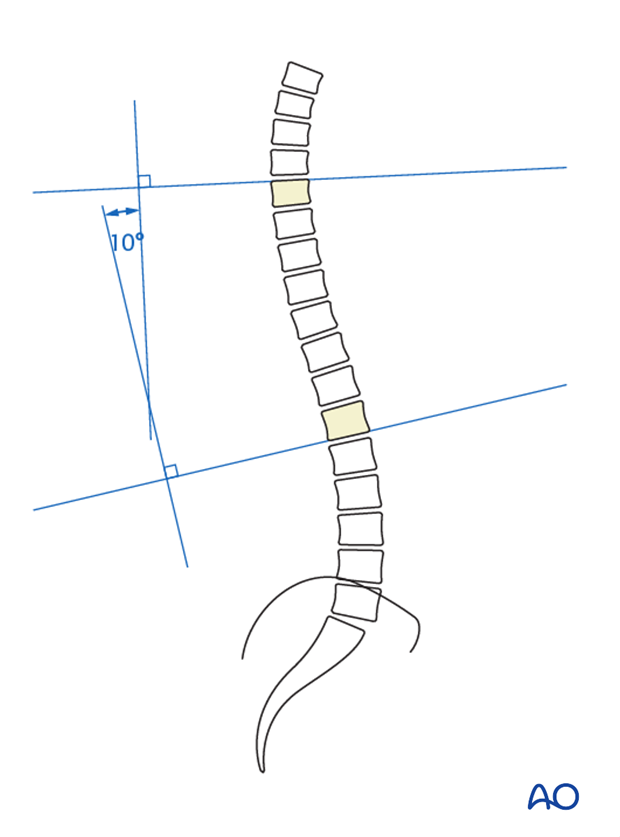 lenke classification