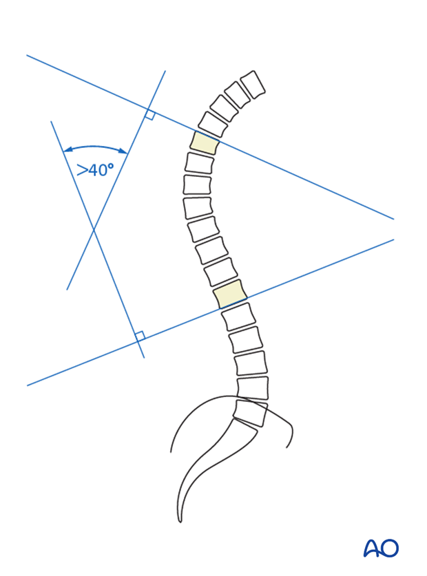 lenke classification