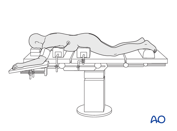 preparation posterior procedures