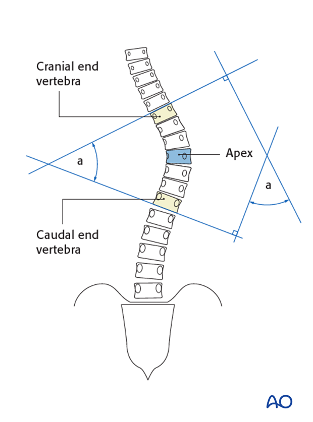 lenke classification