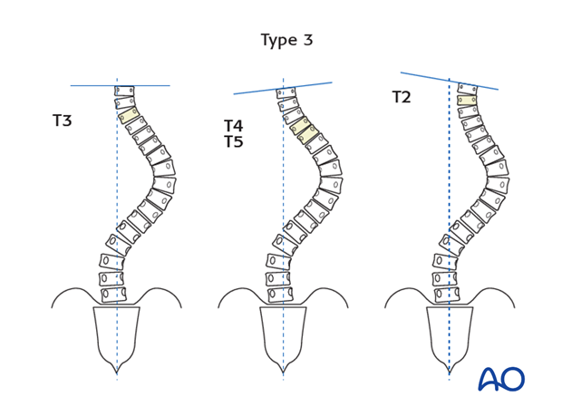 selection of fusion level