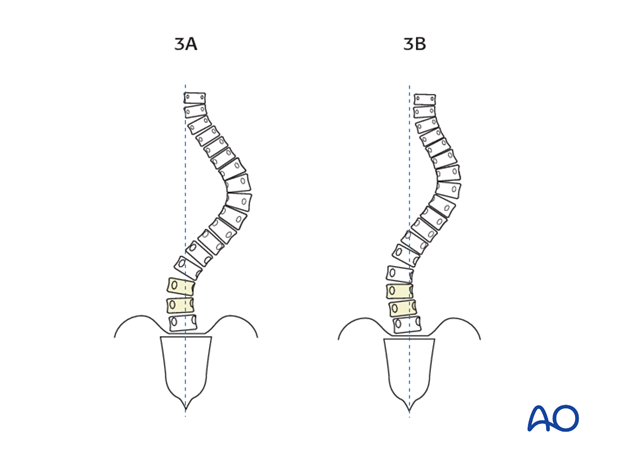 selection of fusion level