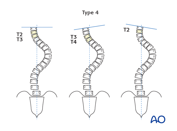 selection of fusion level