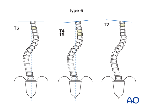 selection of fusion level