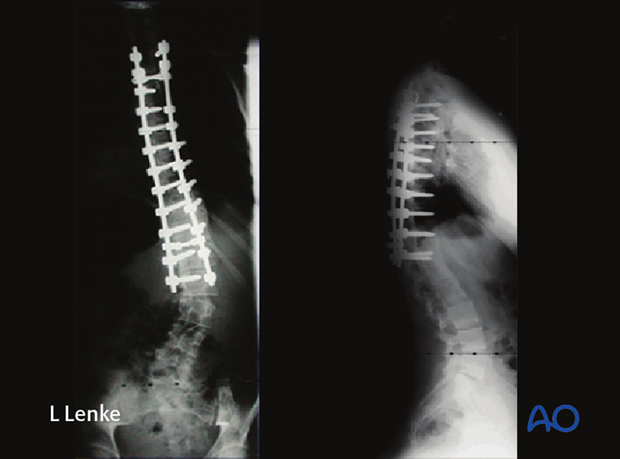 immature patients abnormal neuroaxis body habitus