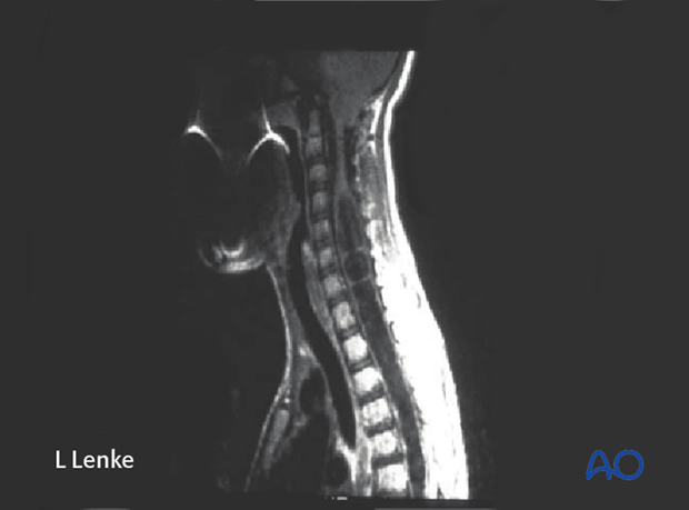 immature patients abnormal neuroaxis body habitus