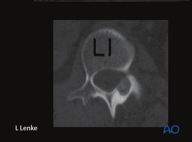 immature patients abnormal neuroaxis body habitus