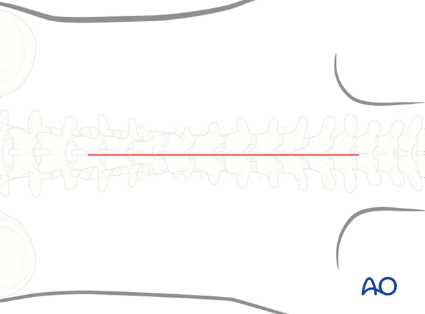 posterior instrumentation without release