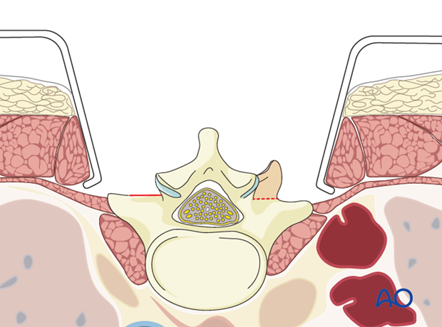 posterior approach