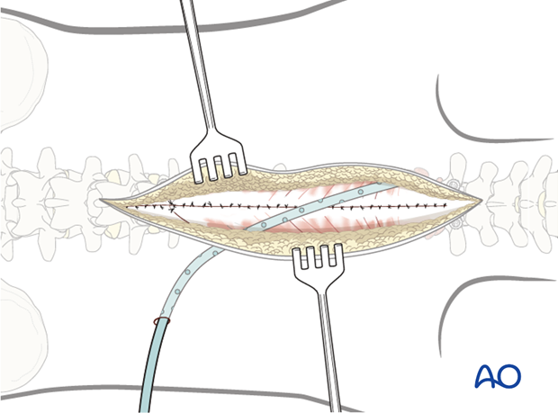 posterior approach