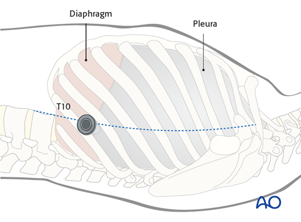 anterior thoracoscopic release