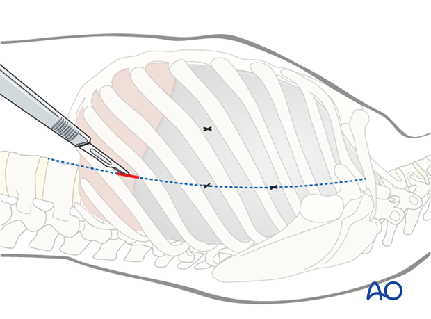 anterior thoracoscopic release