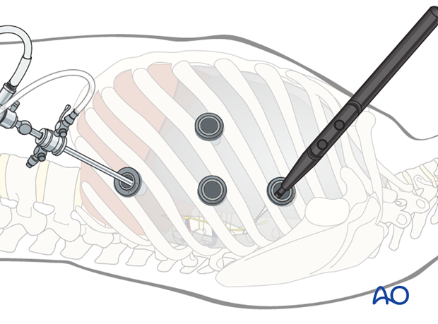 anterior thoracoscopic release