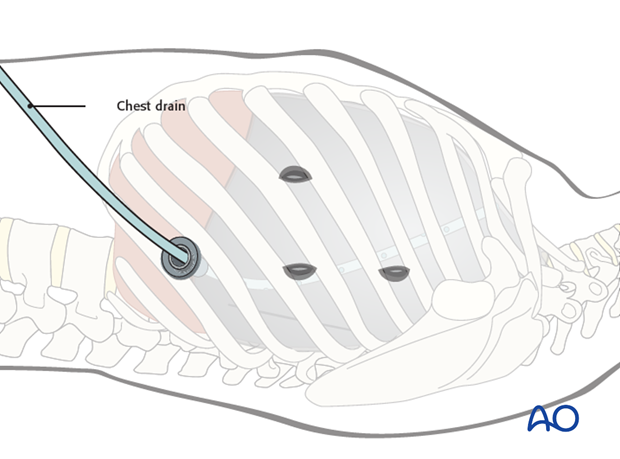 anterior thoracoscopic release