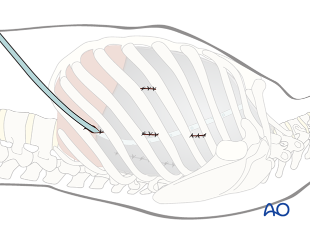 anterior thoracoscopic release