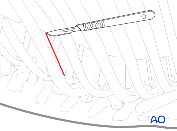 minimally invasive left side thoracic approach