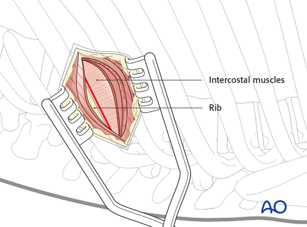 minimally invasive left side thoracic approach