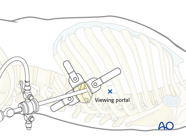 minimally invasive left side thoracic approach