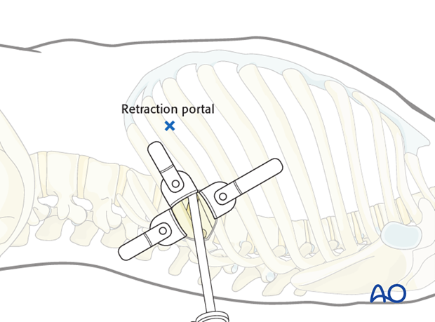 minimally invasive left side thoracic approach